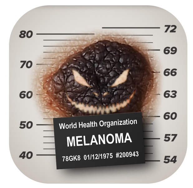 Melanoma