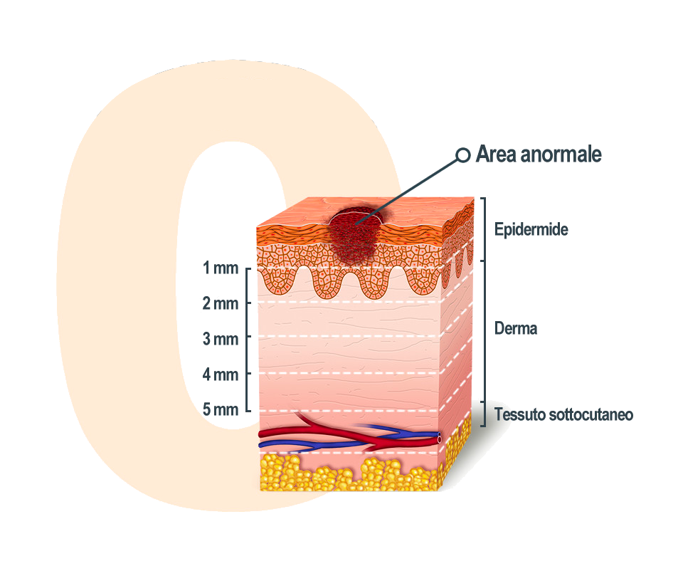 stadio 0 melanoma