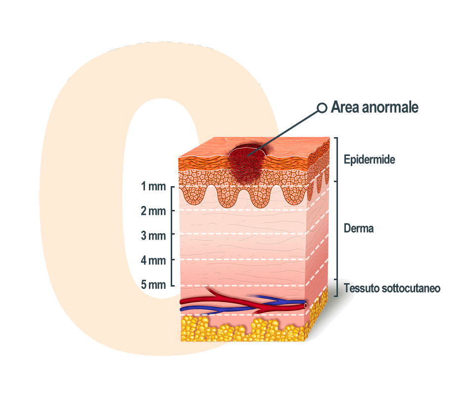 stadio 0 melanoma