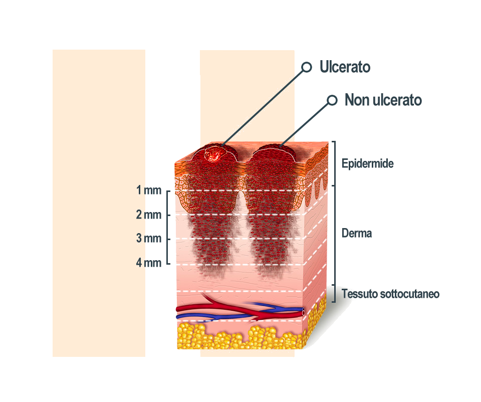 Stadio 2 melanoma