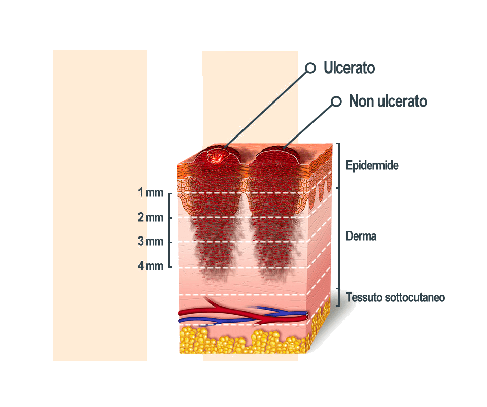 Stadio 2 melanoma