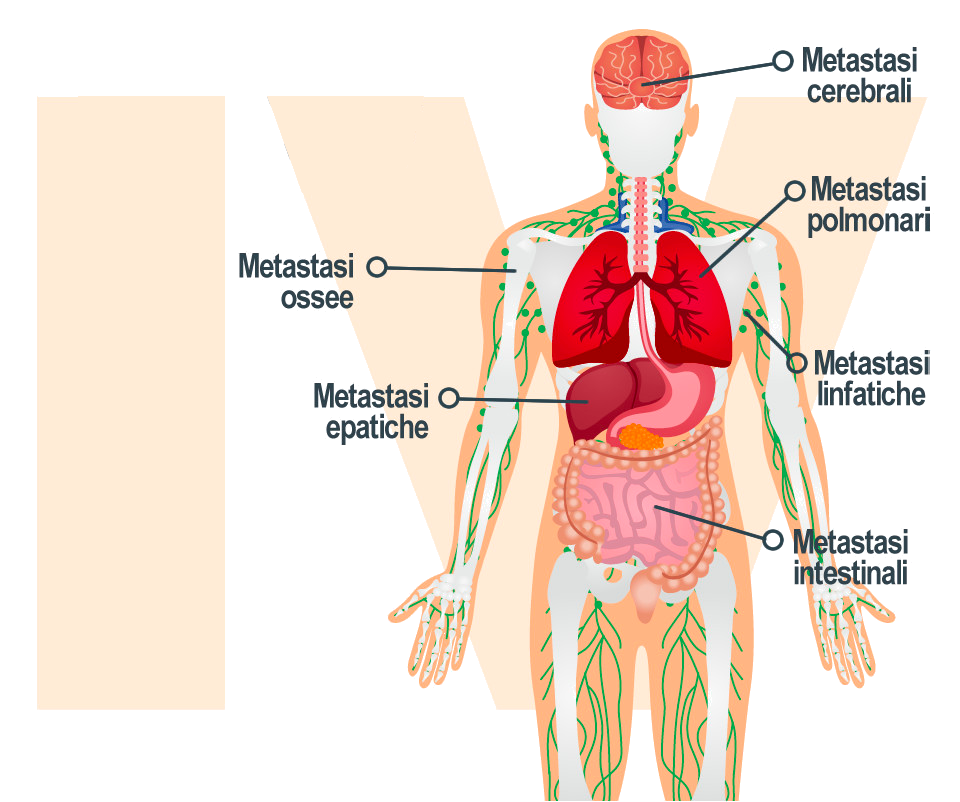 stadio 4 melanoma