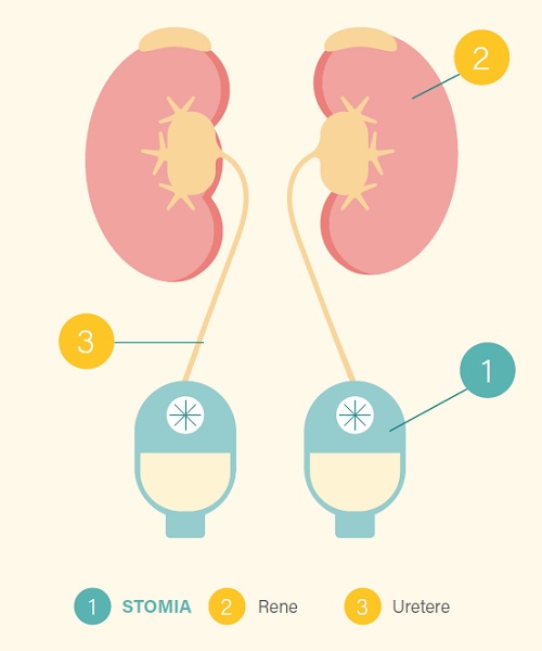 Urostomia prima tipologia