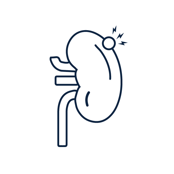 Carcinoma_uroteliale-Distenzione del rene