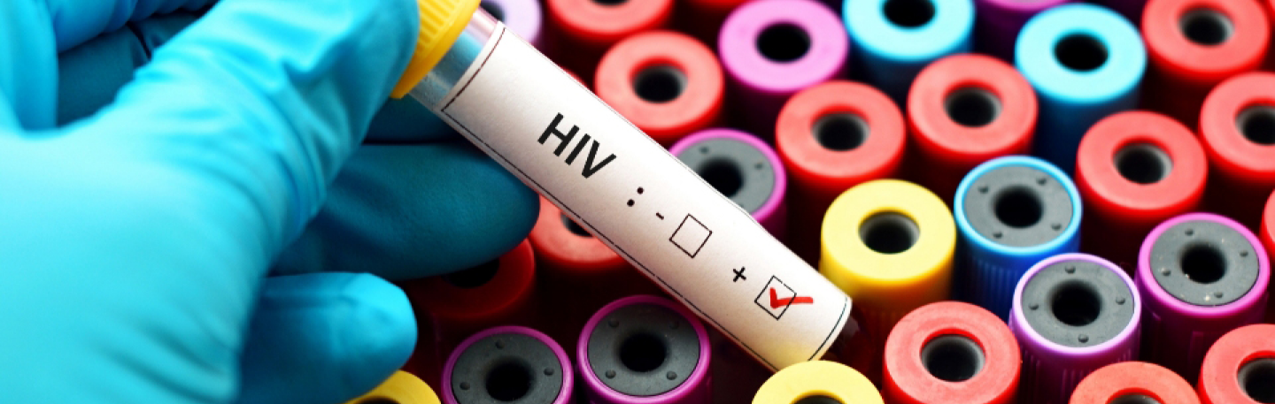 test HIV